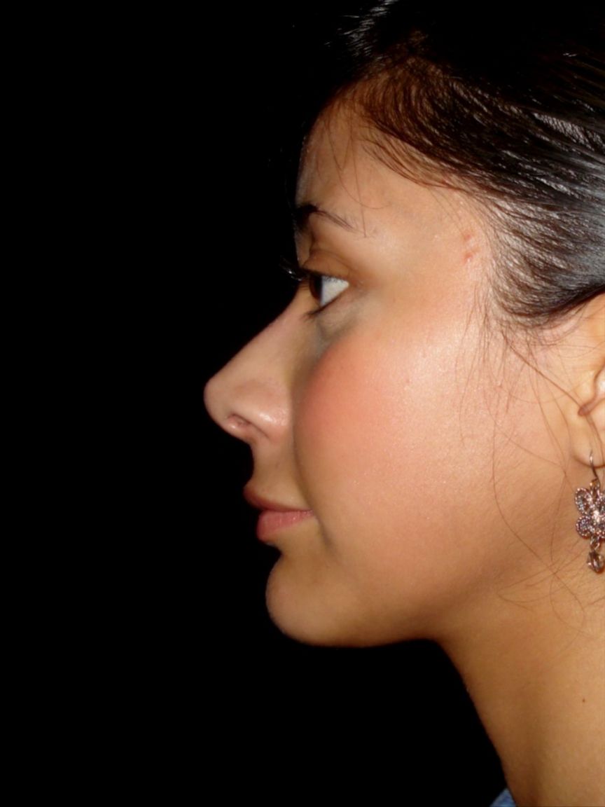 Rhinoplasty