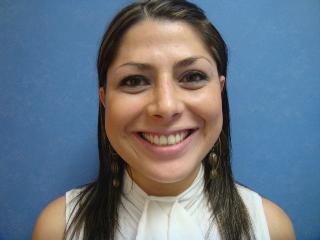 Rhinoplasty