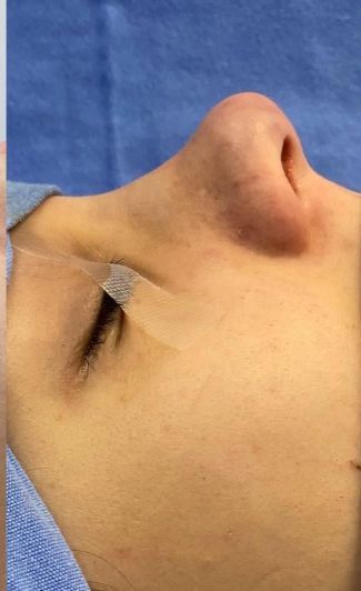 Rhinoplasty