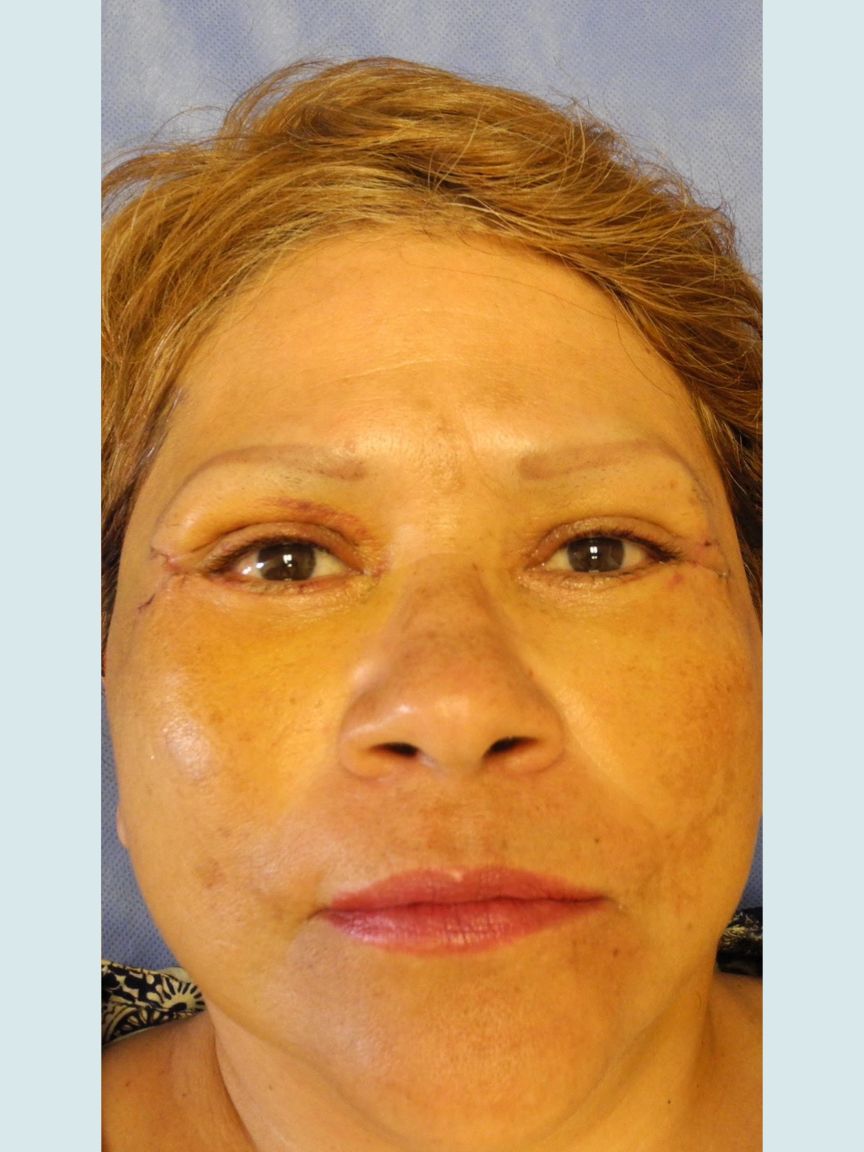 Facelift with Blepharoplasty