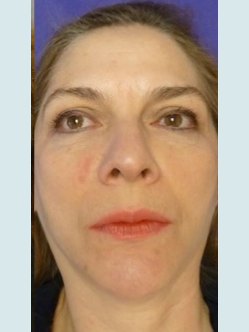 Facelift with Blepharoplasty