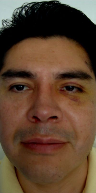 Rhinoplasty
