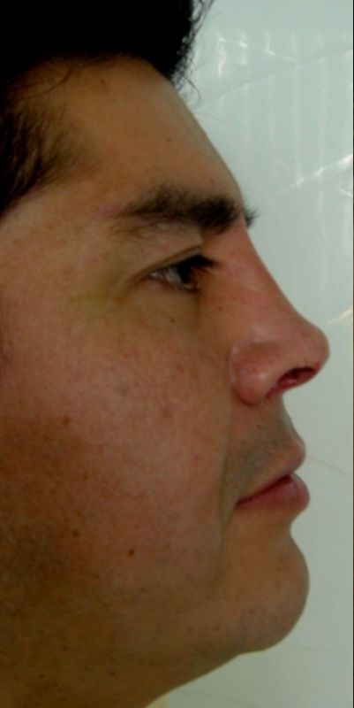 Rhinoplasty