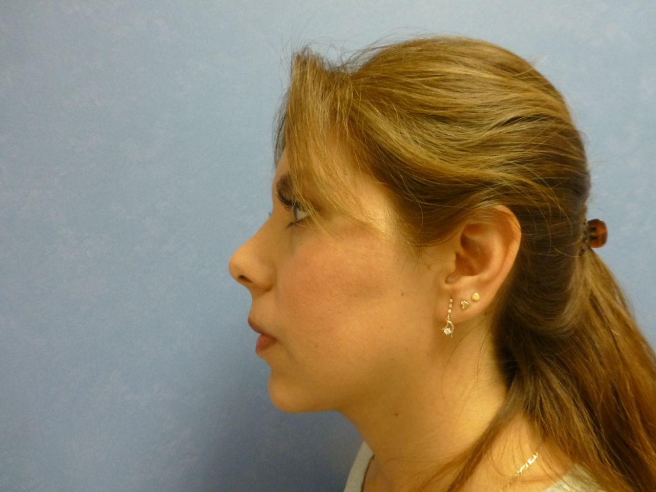 Rhinoplasty
