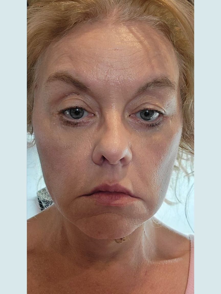 Facelift with Blepharoplasty