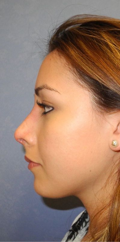 Rhinoplasty