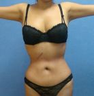 Liposuction