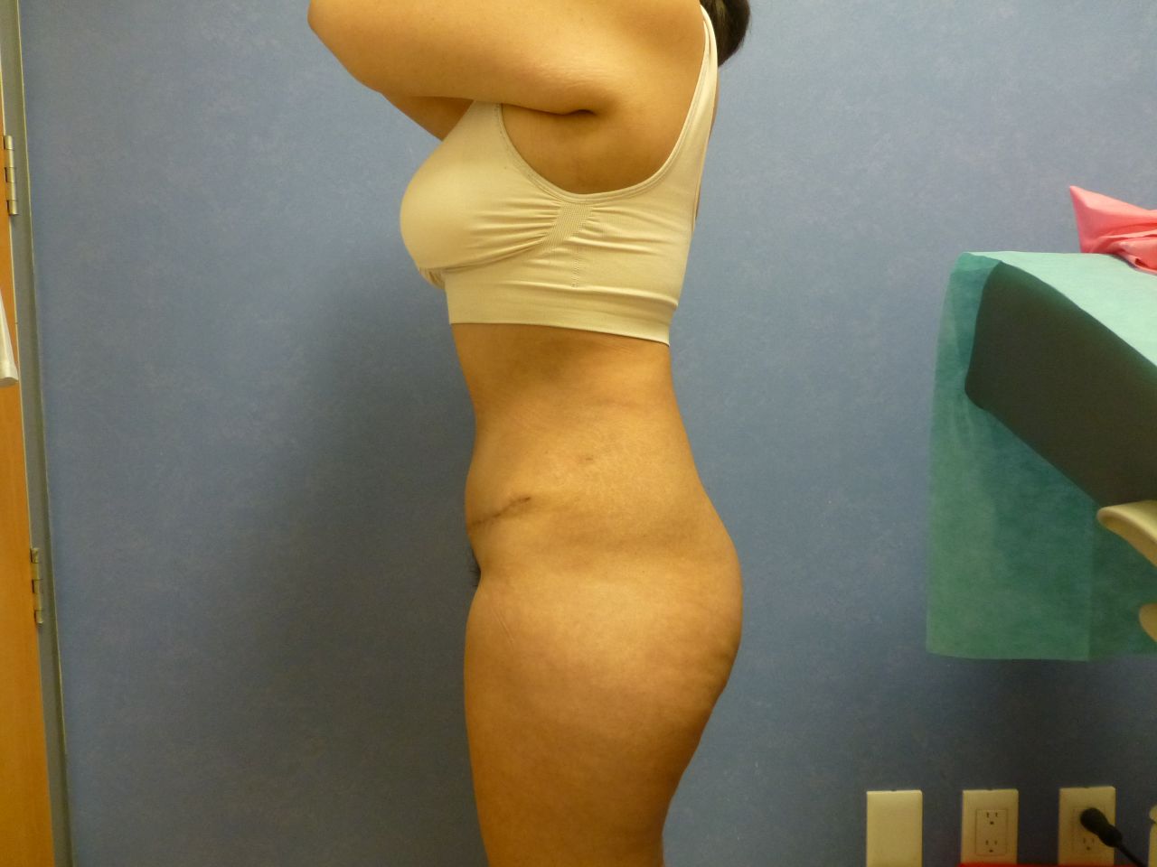 Tummy Tuck