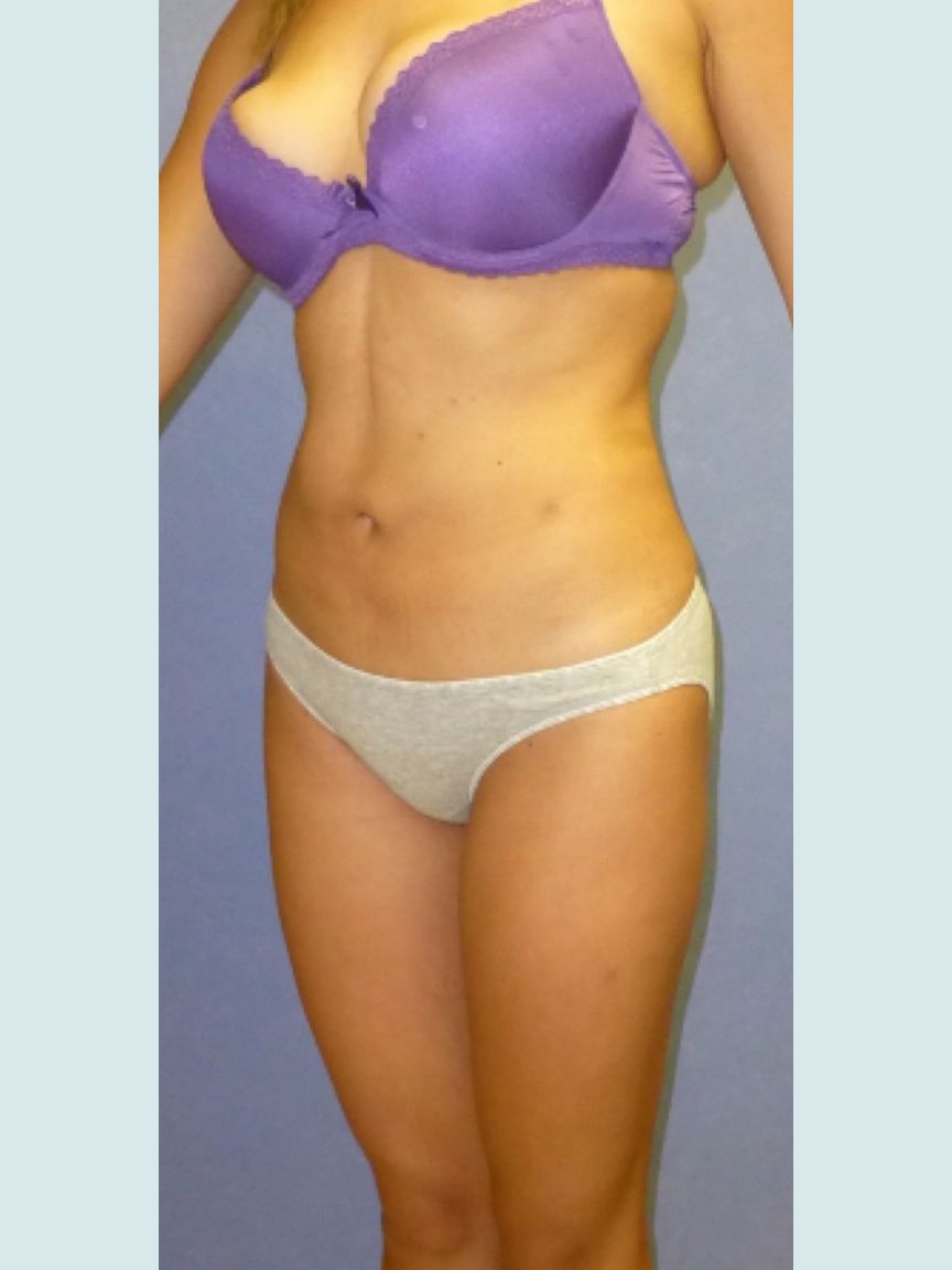 Liposuction