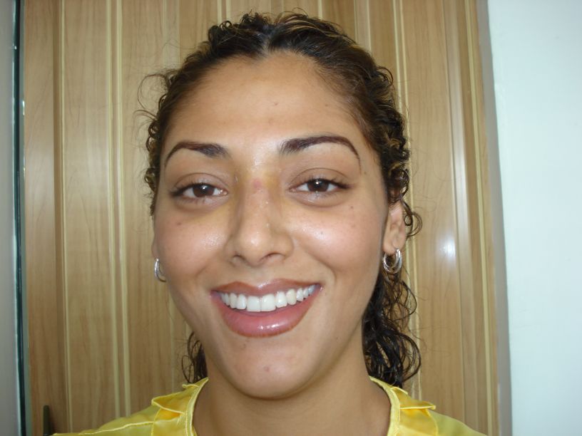 Rhinoplasty