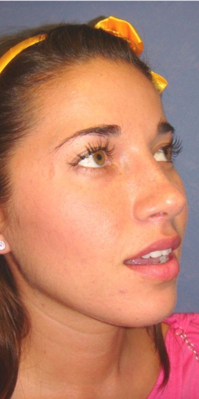 Rhinoplasty