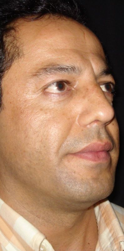 Rhinoplasty