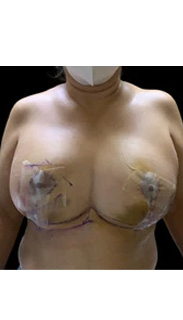 Breast Reduction