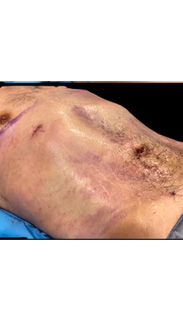 Liposuction