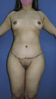 Tummy Tuck