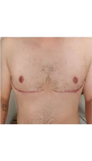 Mastectomy