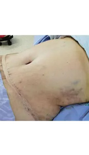 Tummy Tuck
