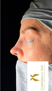 Rhinoplasty