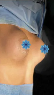 Breast Augmentation