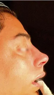 Rhinoplasty