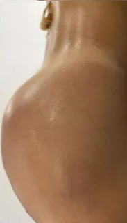 Brazilian Butt Lift