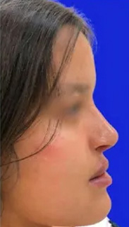 Rhinoplasty