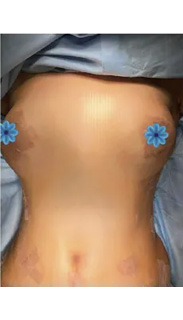 Breast Augmentation