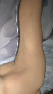Arm Lift