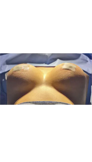 Breast Augmentation