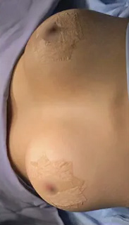 Breast Augmentation