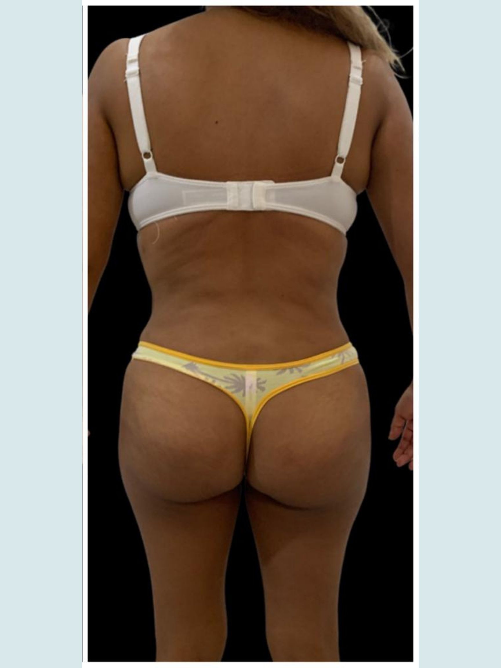 Brazilian Butt Lift