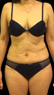 Tummy Tuck