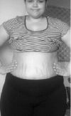 Weight Loss Surgery