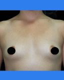 Breast Augmentation