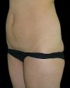 Liposuction w/ BBL