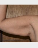 Arm Lift