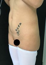 Tummy Tuck