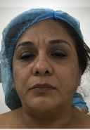 Facelift w/ Blepharoplasty