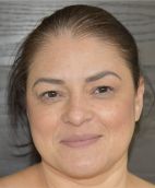Blepharoplasty