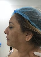 Facelift w/ Blepharoplasty