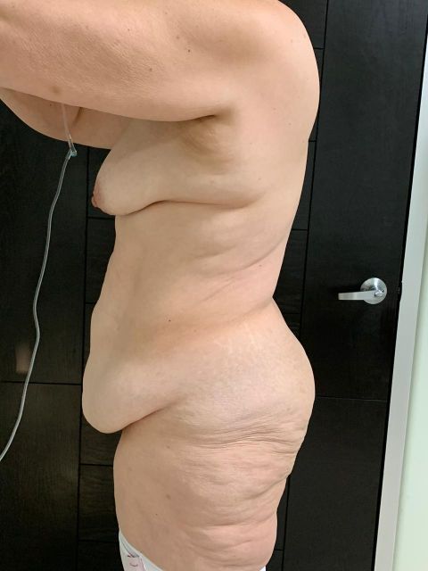 Circular Tummy Tuck w. Lipo