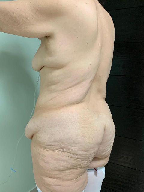 Circular Tummy Tuck w. Lipo