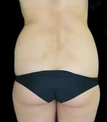 Liposuction w/ BBL