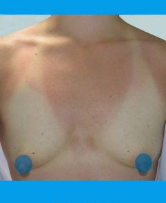 Breast Augmentation