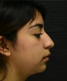 Rhinoplasty
