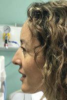 Facelift w/ Blepharoplasty
