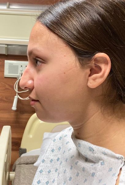 Rhinoplasty