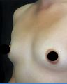 Breast Augmentation