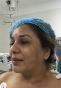 Facelift w/ Blepharoplasty