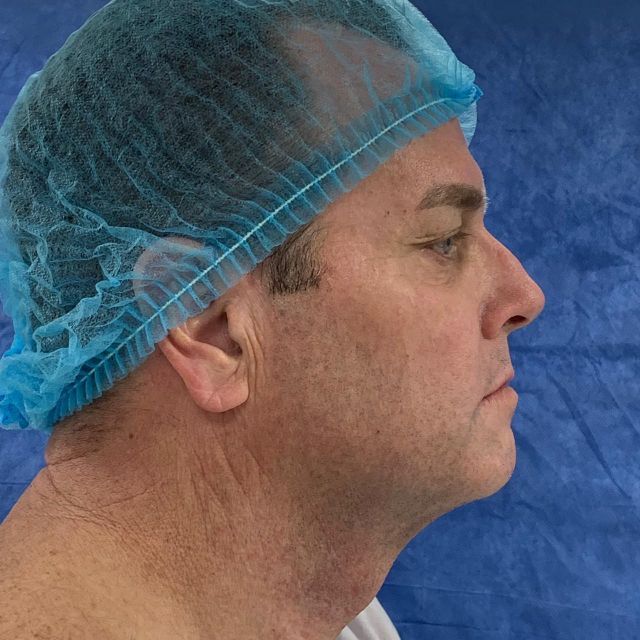 Full Facelift w/ Rhinoplasty